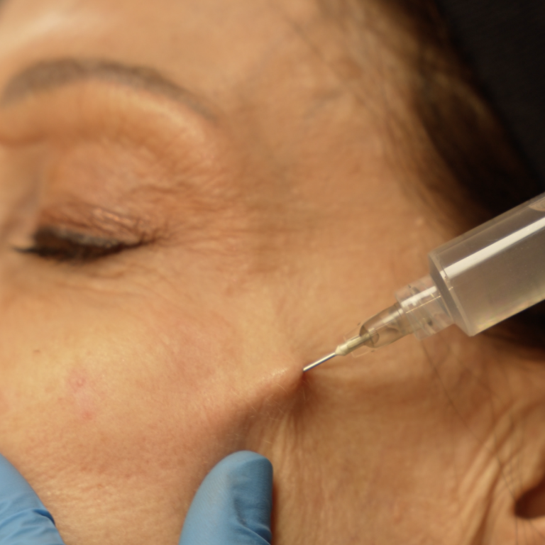 Les inducteurs collagéniques soins injectables Néocollagénèse intense