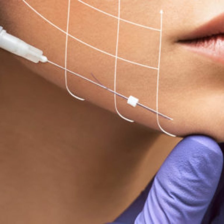 Facial,Lifting,Fils tenseurs résorbables hydres docteur Simon audrey